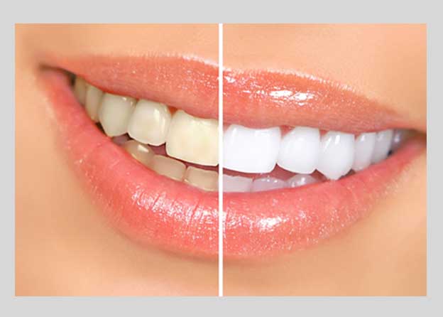 Tooth whitening - Orocare