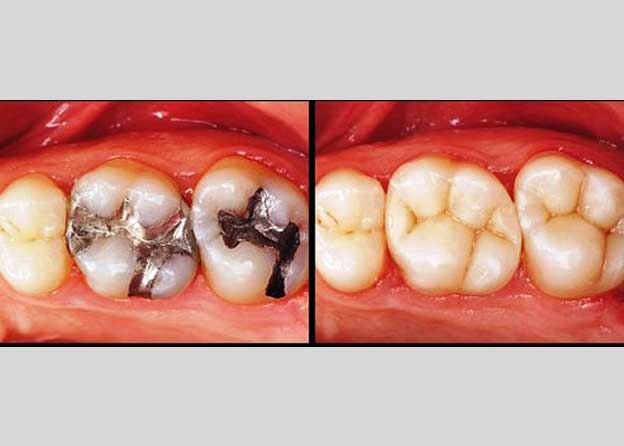 Esthetic dentistry (Filling) - Orocare