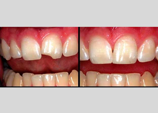 Esthetic dentistry (Bonding) - Orocare