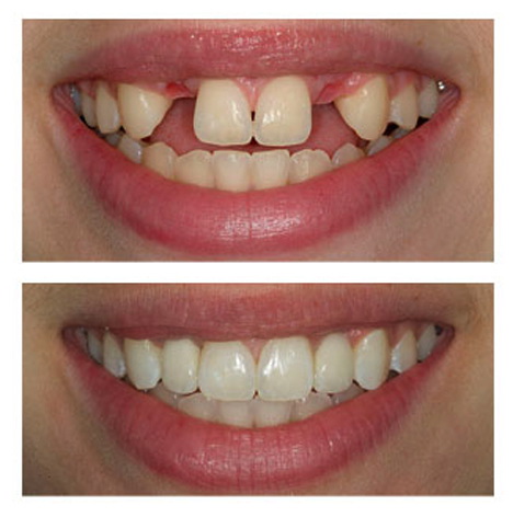 Dental Implants - Orocare